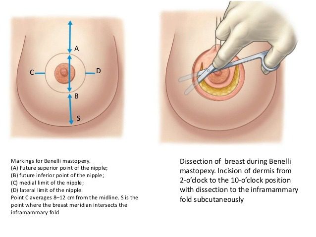 BREAST LIFT WITH MINIMAL SCARRING
