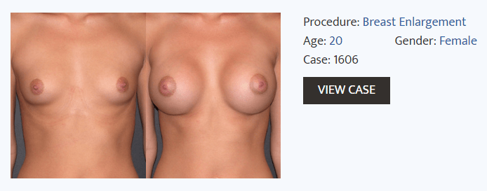 breast augmentation before and after - Dr Fialia