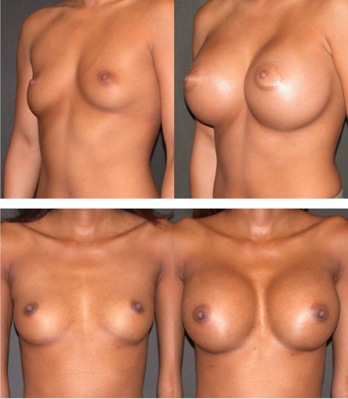 Breast Augmentation Surgery.
