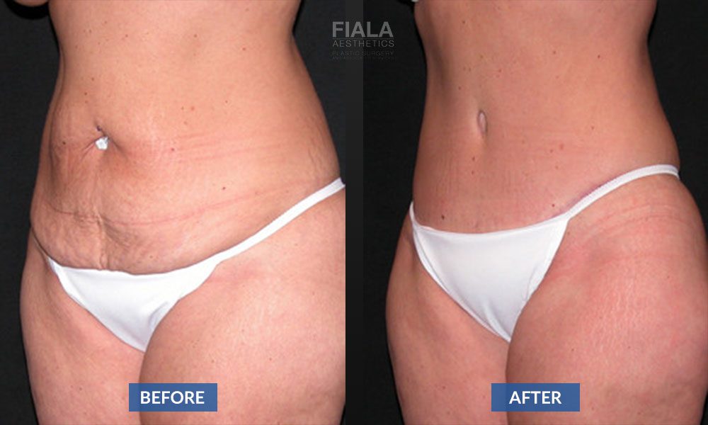 Why Should I Consider a Tummy Tuck After Pregnancy? - Thomas